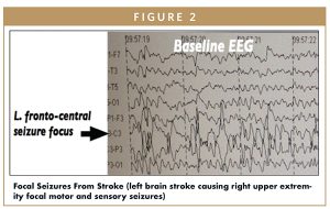 Focal Seizures From Stroke (left brain stroke causing right upper extremity focal motor and sensory seizures)