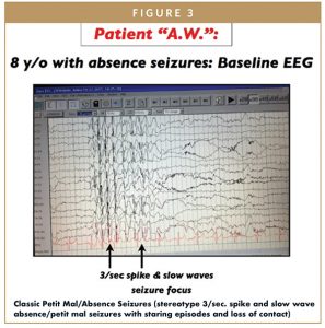 Classic Petit Mal/Absence Seizures (stereotype 3/sec. spike and slow wave absence/petit mal seizures with staring episodes and loss of contact)