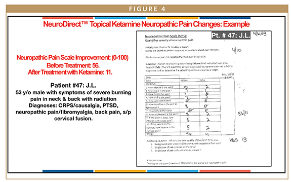 Delivery Technology Topical Neurodirect™ Ketamine In The Treatment Of Neuropathic Pain