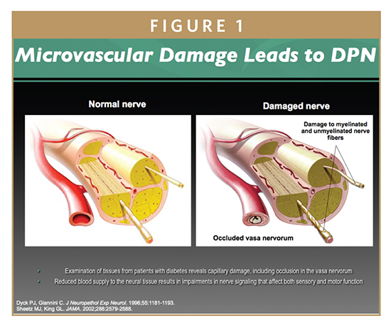 Interferential Therapy for Diabetic Neuropathy & Lower Leg Pain — RS Medical