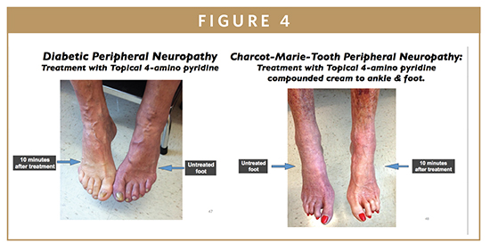 Therapeutic Focus Direct Effects Tm Diabetic Neuropathy Therapy